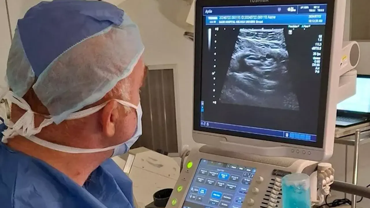 نجاح علاج ورم ليفي بالقسطرة عوض الجراحة بجامعة العاصمة